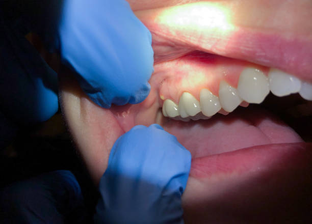 Best Emergency Dental Care for Broken or Chipped Teeth in Eyota, MN